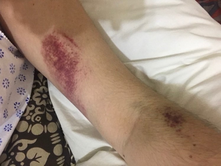 HELLP Survivor bruised arm