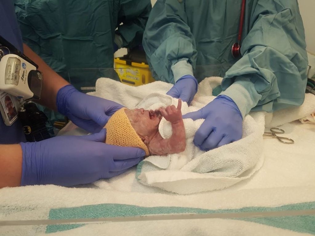 Birth Trauma and Preeclampsia:
baby with nurses